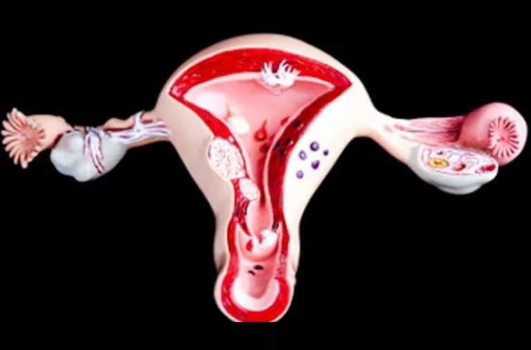 Uterine Abnormalities